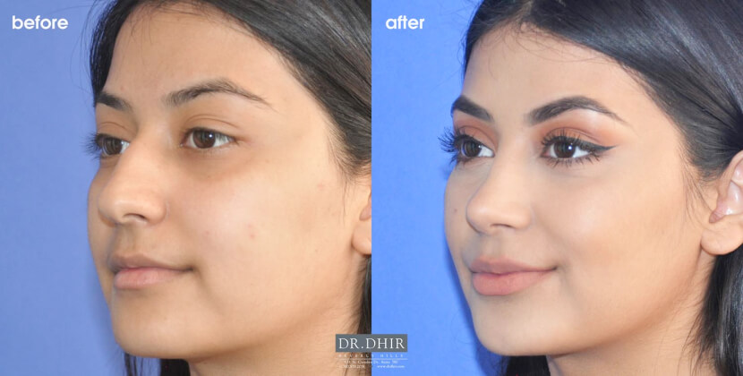 3/4th view of Before and After picture of a Rhinoplasty female patient