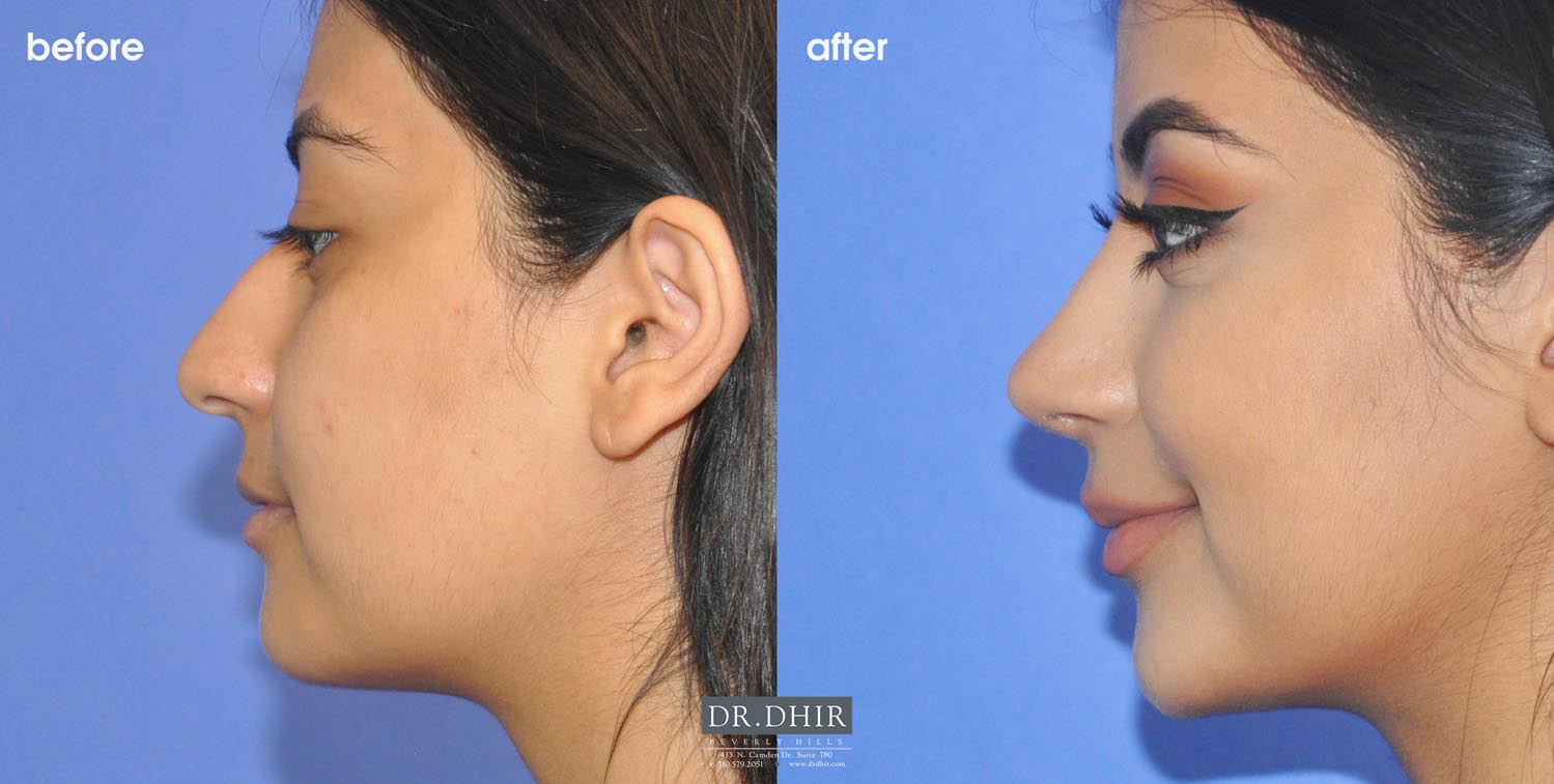 Side view of Before and After picture of a Rhinoplasty female patient