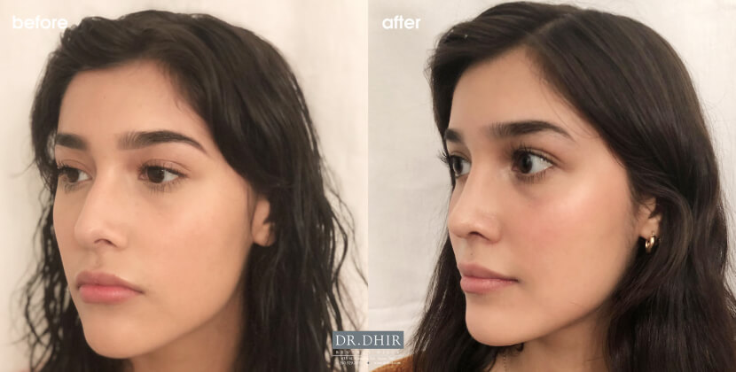 Before and After picture of a Rhinoplasty female patient