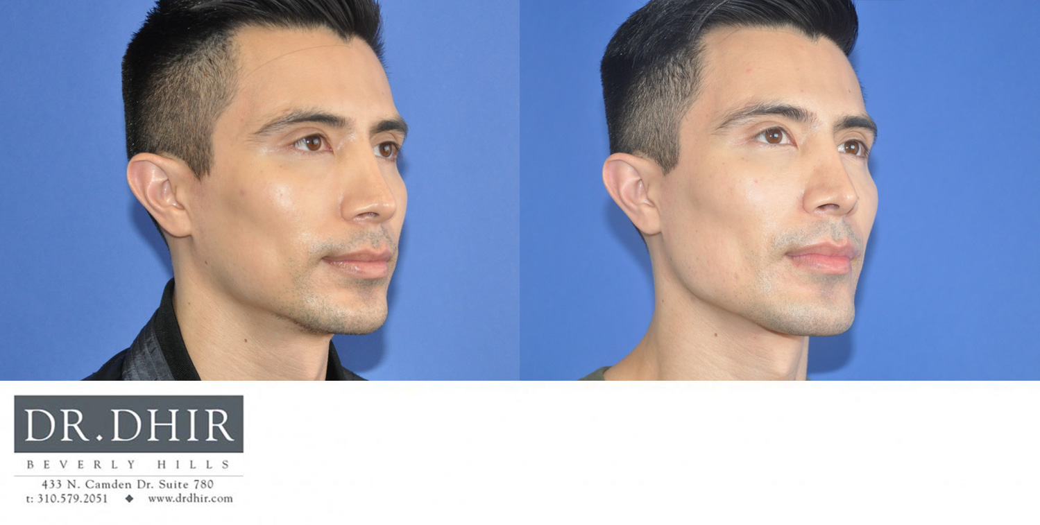 facial implants