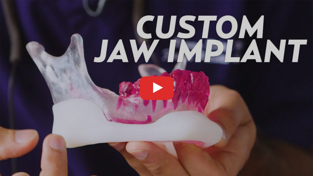 Custom Facial Implant